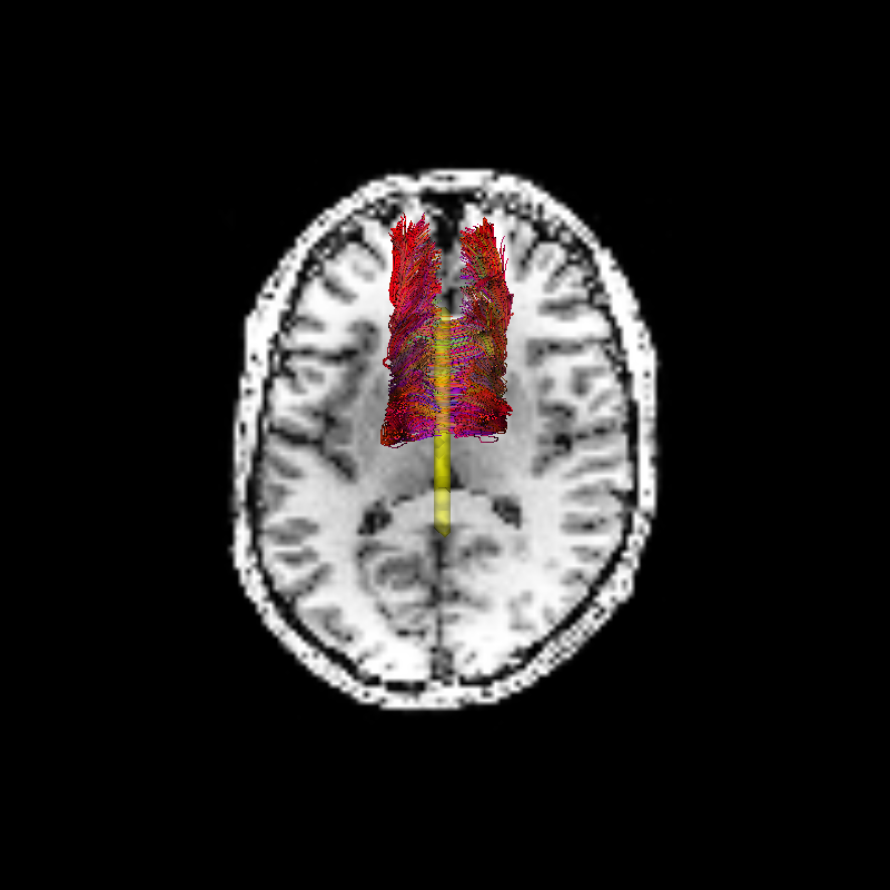 linear fascicle evaluation